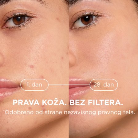 Sebium Kerato+ rezultati