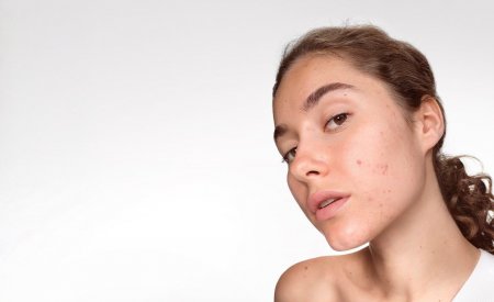 Sebium koža sklona aknama