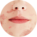 moderate to severe acne