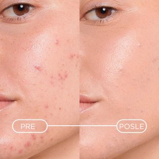 Sebium Kerato+ Cover