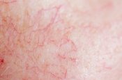 Slika kože - Koža za crvenilom i vidljivim kapilarima